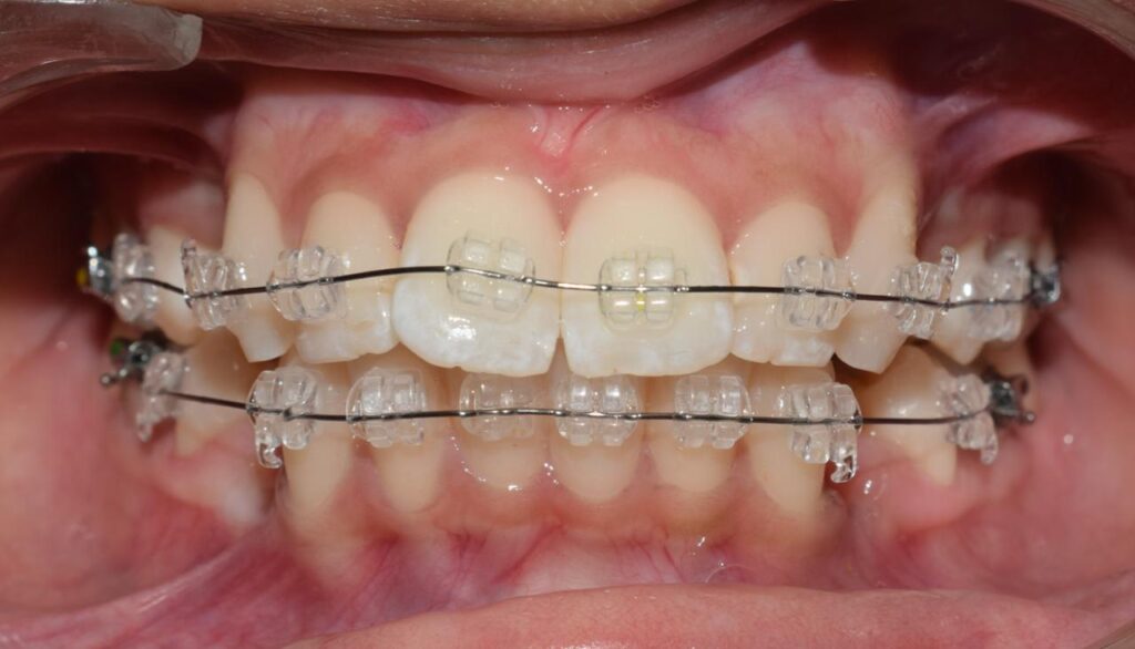 Ceramic braces