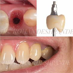 dental implants cost in pune