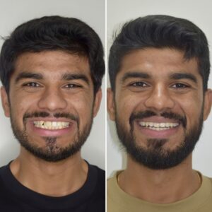 adult treatment with Invisalign clear aligners before after photo