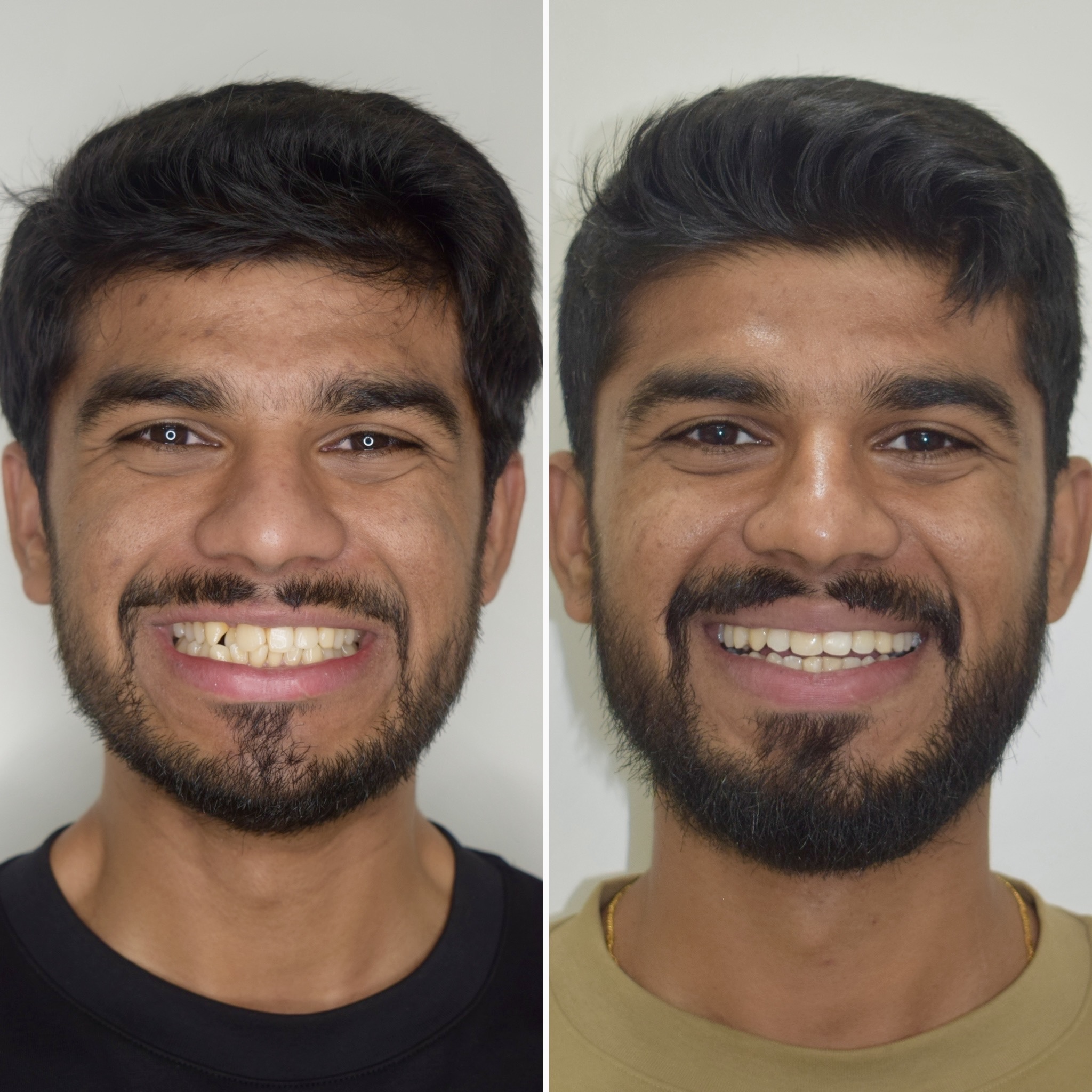 adult treatment with Invisalign clear aligners before after photo