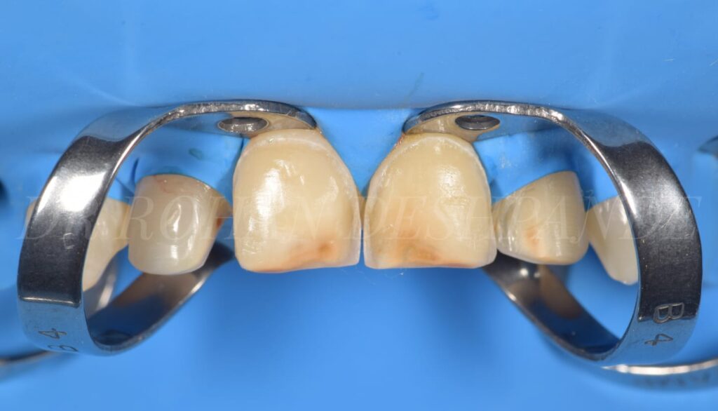 dental-crowns-bridges
