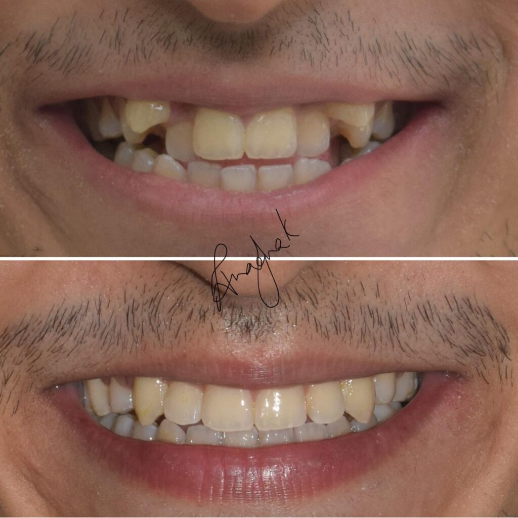 how long do braces take to straighten teeth