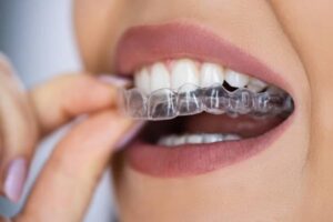 invisalign cost pune