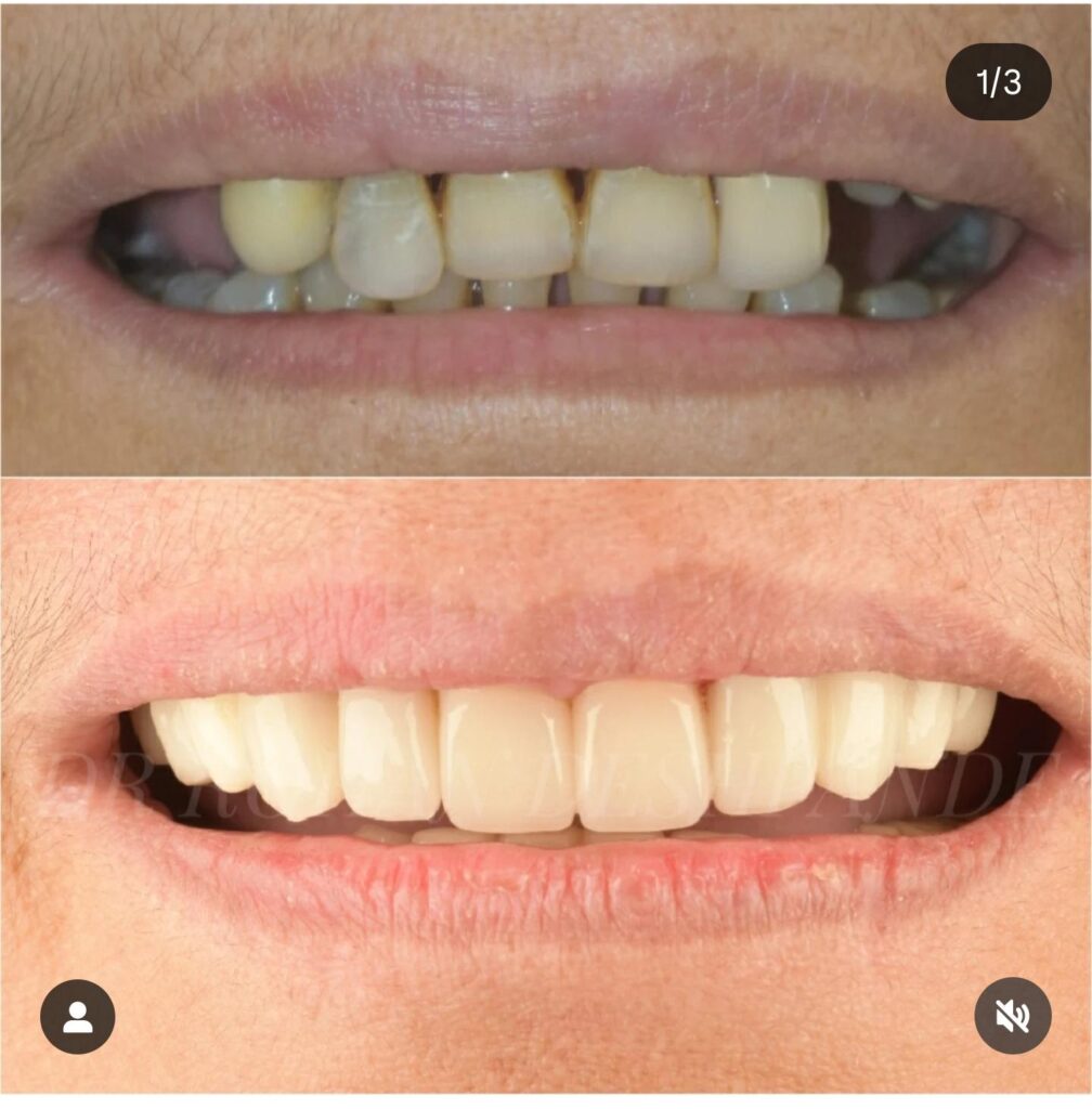porcelain-veneers