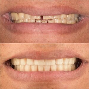 smile makeover
