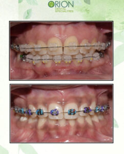 metal vs ceramuc braces