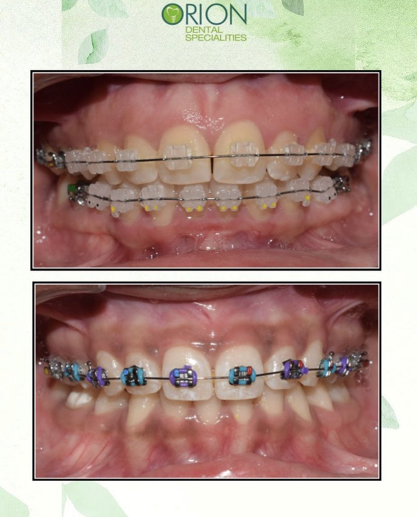 metal vs ceramuc braces