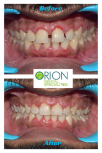 teeth gap treatment