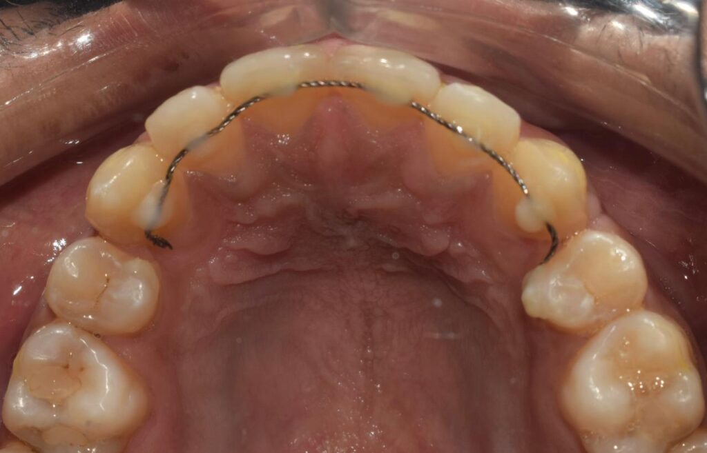 Fixed wired retainers
