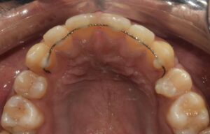 Fixed wired retainers