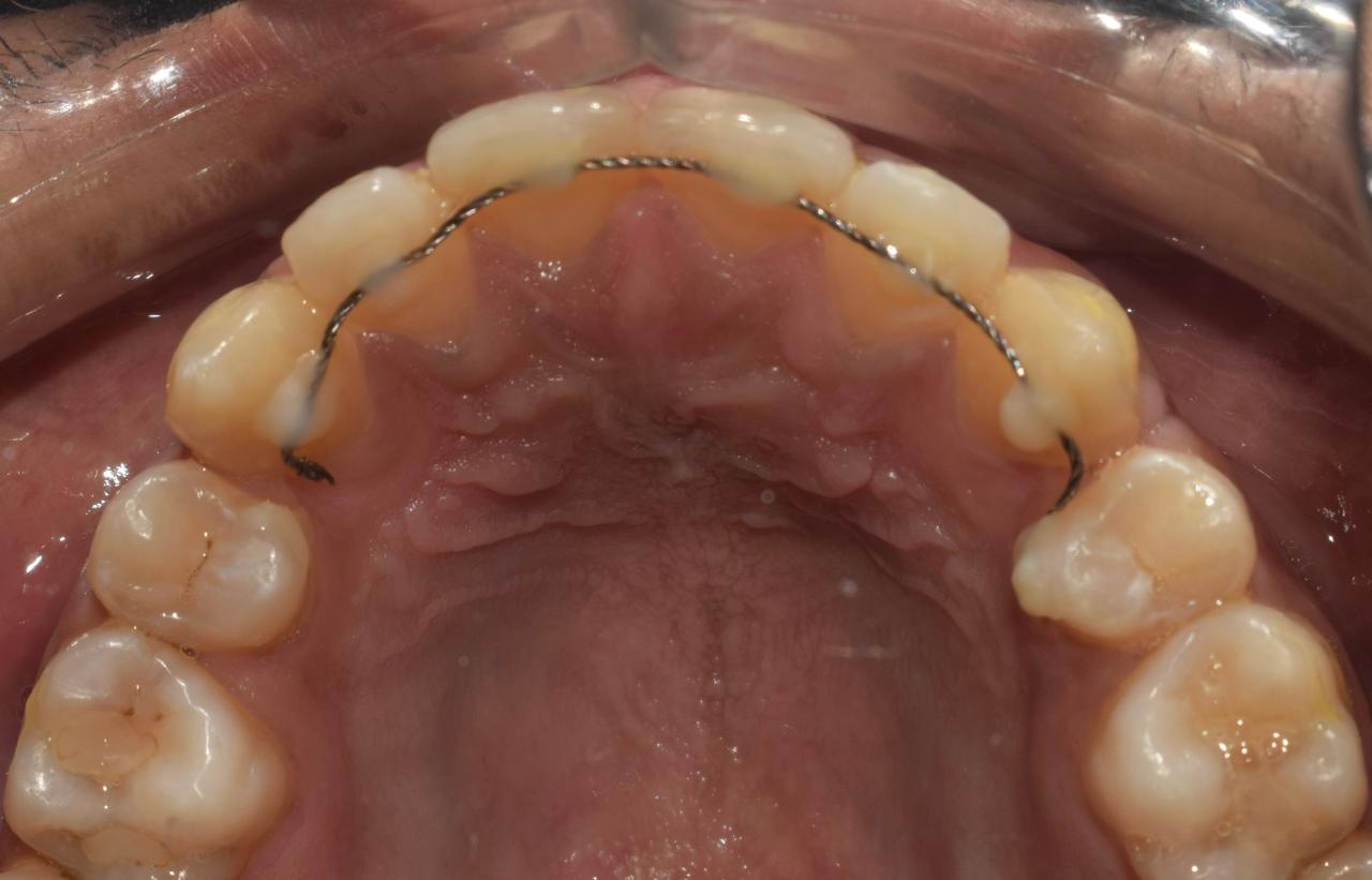 Fixed wired retainers