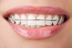 Removable Wire Retainers
