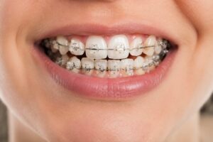 Self litigating braces