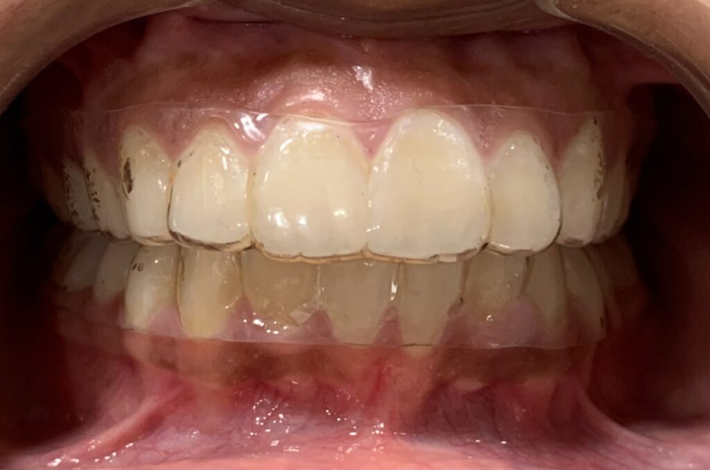 Transparent Retainers