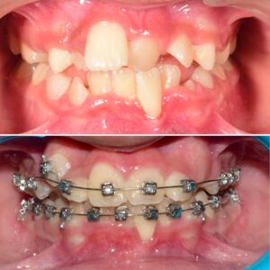 braces for kids