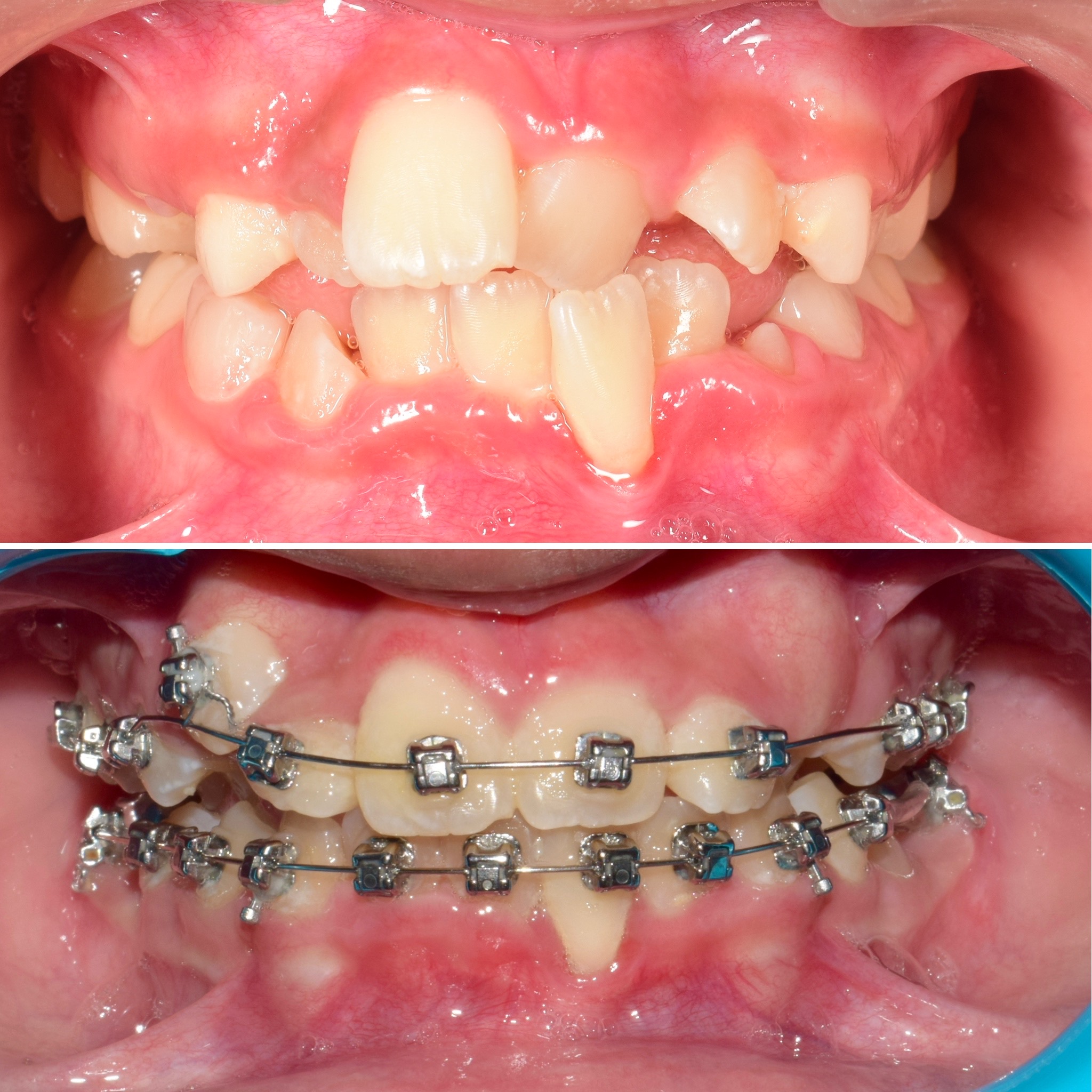 braces for kids
