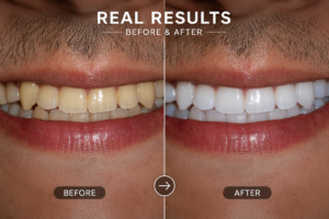 Before-vs-After-teeth-Whitening