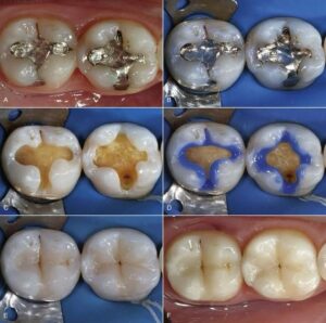 dental fillings