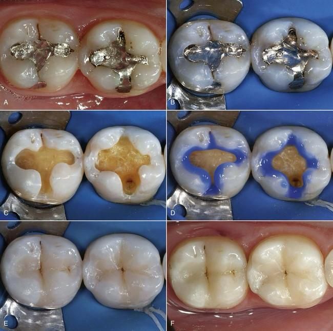 dental fillings